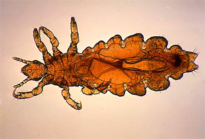 picture of head lice
