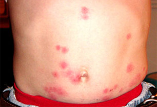 Bedbug bites on stomach